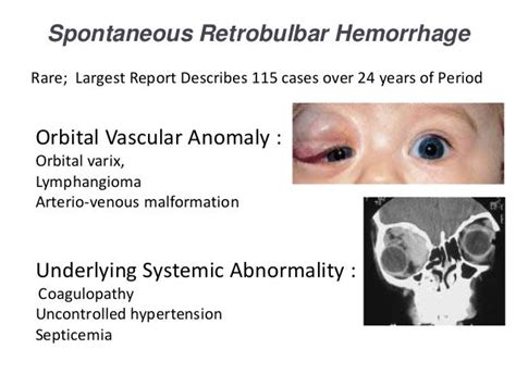 Retrobulbar Haemorrhage