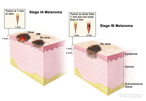 Stage 1 Melanoma Diagnosis - XpertPatient