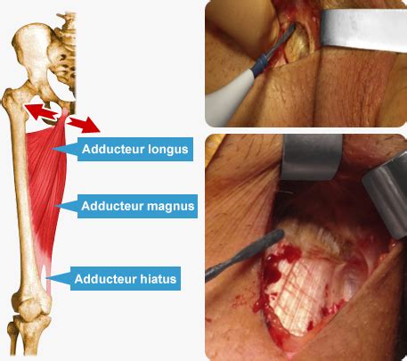 Traitement Chirurgical De La Pubalgie Des Adducteurs Pubalgie