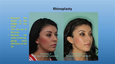 Nose Surgery Tijuana Baja California Mx Rhinoplasty