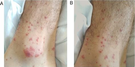 Palpable Non Blanching Purpuric Rash Compatible With Cutaneous Download Scientific Diagram