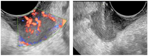 Jcm Free Full Text Ultrasound Guided Tru Cut Biopsy In