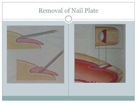 Nail Biopsy