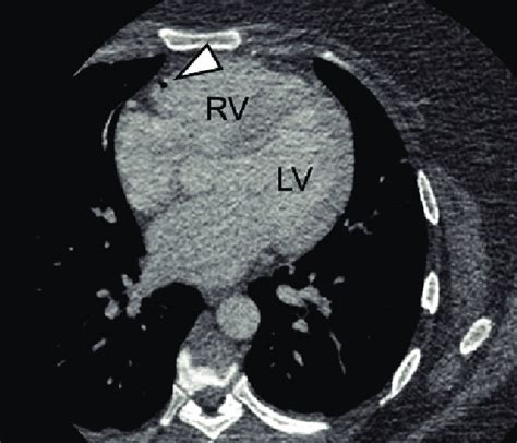 An Air Embolus Arrowhead Along The Anterior Wall Of The Right