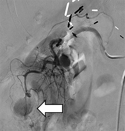 The Renal Vasculature What The Radiologist Needs To Know Radiographics