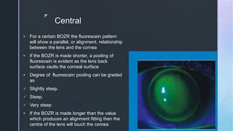 Fitting Spherical Rigid Gas Permeable Contact Lens Ppt