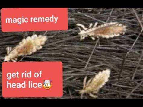 How To Get Rid Of Head Lice Saar Ki Jooainmagic Tips Youtube