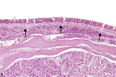 Nose Epithelium Fibrosis Nonneoplastic Lesion Atlas