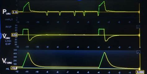 Understanding Ventilator Basics And Ventilator Waveforms RT