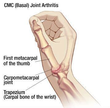 CMC Joint Disorder Dr. Badia Hand and Thumb Surgery Orthopedic Surgeon Dr. Alejandro Badia ...