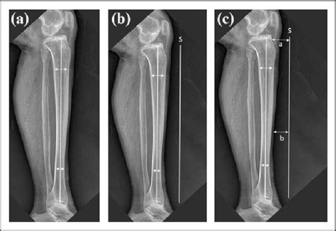 Tibia Lateral View