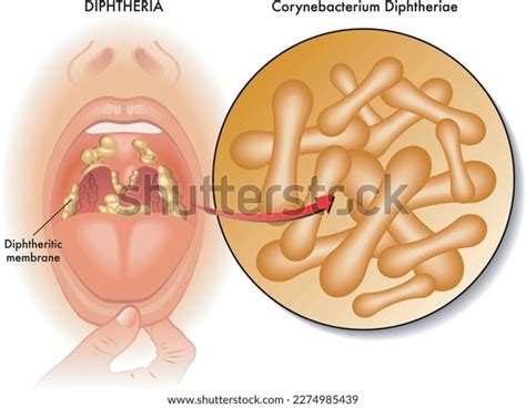 Medical Illustration Symptoms Diphtheria Annotations Stock Vector