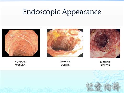 發炎性腸道疾病 Inflammatory Bowel Disease