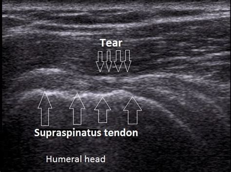 The Complete Guide To A Rotator Cuff Tear Kinetic Labs Toronto Physiotherapy Chiropractic