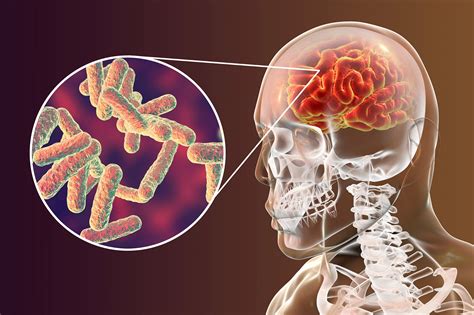 4 fatos sobre a Meningite Meningocócica Vacine Clínica