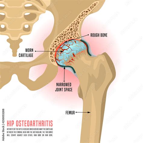 Hip Osteoarthritis Infographic Stock Vector | Adobe Stock