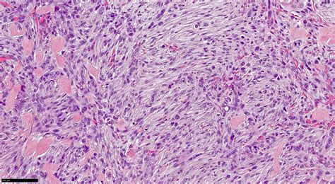 Morpheaform Basal Cell Carcinoma Histology