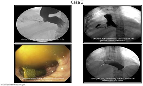 Case Series Of Esophageal Perforations In Achalasia Patients Different