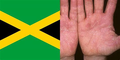 Skin Disease In Jamaica