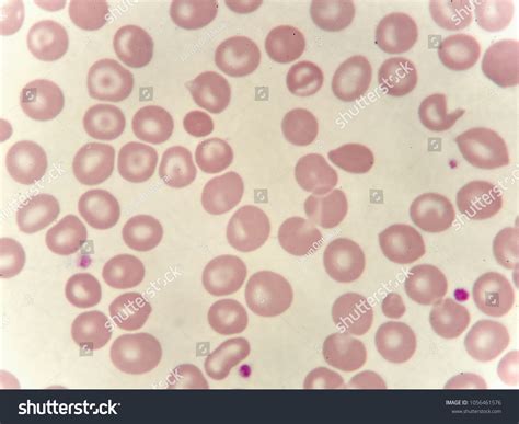 Abnormal Red Blood Cells Thalassemia Patient Stock Photo