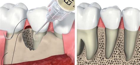 Descubre El Costo De Un Injerto De Hueso Dental Blog Dental Irriak