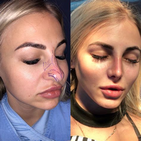 Rhinoplasty Surgery Nose Surgery Facial Fillers Celebrity Plastic