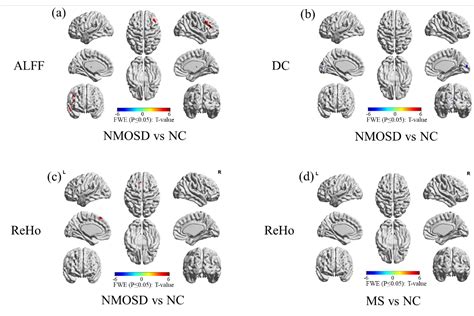 Figure The Difference Of Alff Reho And Dc Betweengroups The