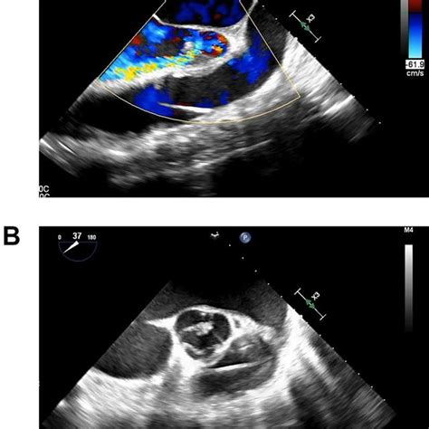 Transesophageal Echocardiography Showing Moderate Aortic Insufficiency