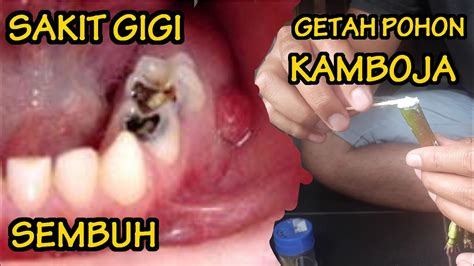 Cara Ampuh Mengobati Sakit Gigi Youtube