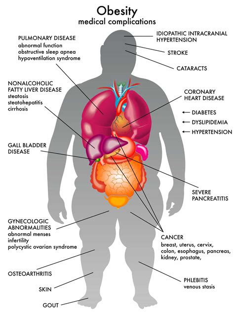 Editorial Overweight Obesity Or Overfat Walking Off Pounds