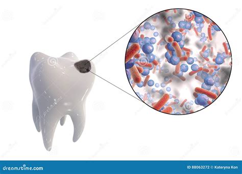 Tand Karies Och Närbildsikt Av Bakterier Som Orsakar Karies Stock