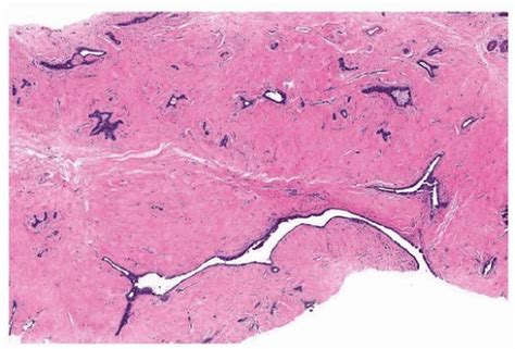 Fibroepithelial Neoplasms Basicmedical Key