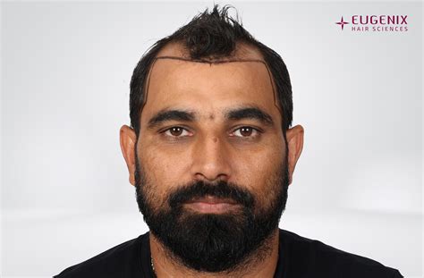 Mohammed Shami Norwood Class 5V Hair Transplant Results And Hair