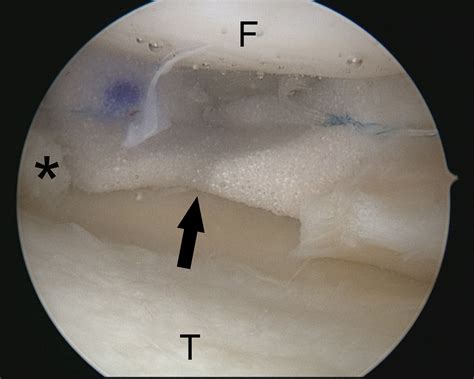 Minced Meniscus Biologic Augmented Meniscal Implant Treatment