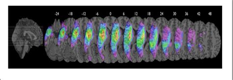 Figure From Tdcs Over The Left Inferior Frontal Cortex Improves