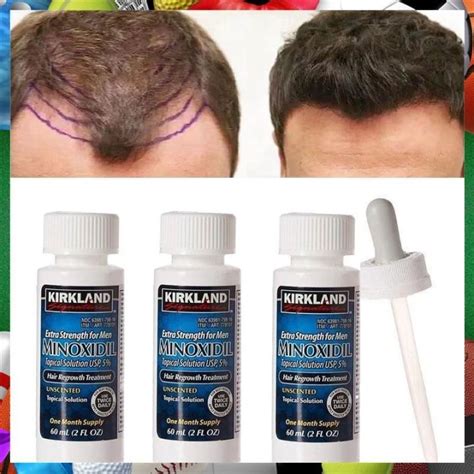 3 Bottle Kirkland Signature Minoxidil For Men 5 Extra Strength Hair