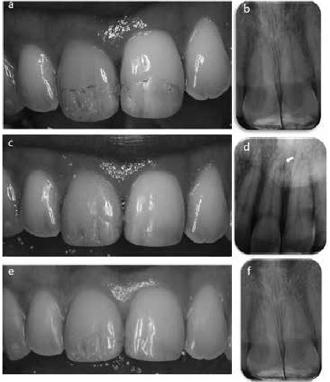 A Post Traumatic Pink Discoloration Of The Right Central Incisor Two