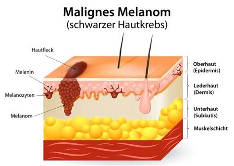 Hautkrebs Malignes Melanom