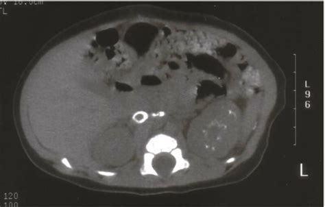 Calcification In The Veins