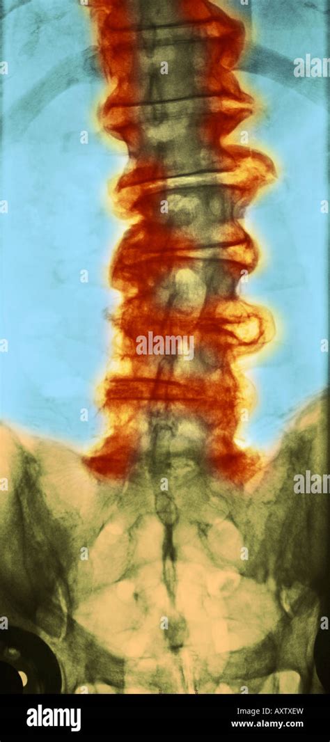 colorized  ray   spine showing severe degenerative