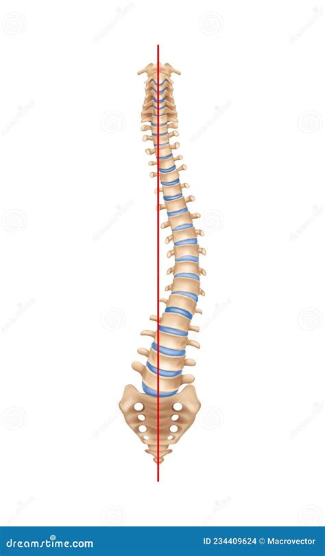 Composici N Realista De Escoliosis Espinal Ilustraci N Del Vector