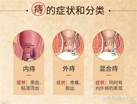 痔疮出血怎么治疗方法 知乎