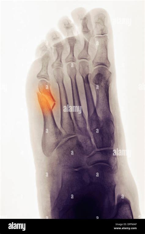 5th Metatarsal Fracture X Ray