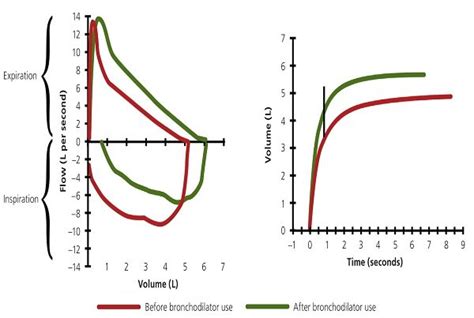 Pulmonary Function Test with Bronchodilator Reversibility - Dr bharat gopal