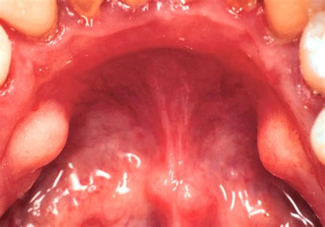 Qué son los torus dentales y cómo se pueden tratar BQDC