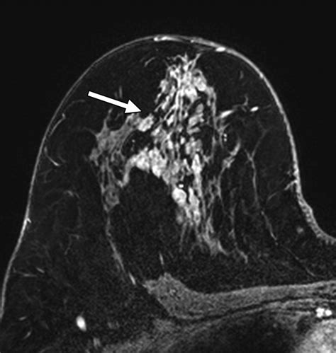 Decision Making For Breast Lesions Initially Detected At Contrast