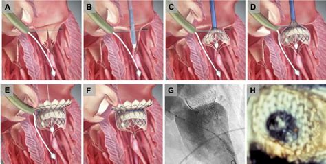 Transcatheter Mitral Valve Replacement