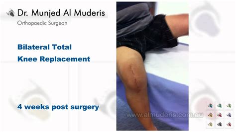 Bilateral Total Knee Replacement 4 Weeks Post Surgery YouTube