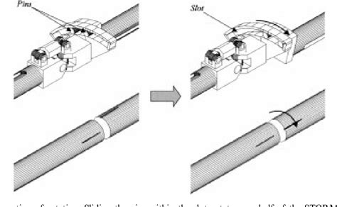 Reduction of fracture | Semantic Scholar