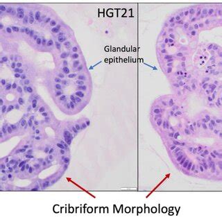 H And E Staining Of Pdos Recapitulate The Malignant Phenotype Hgt Is